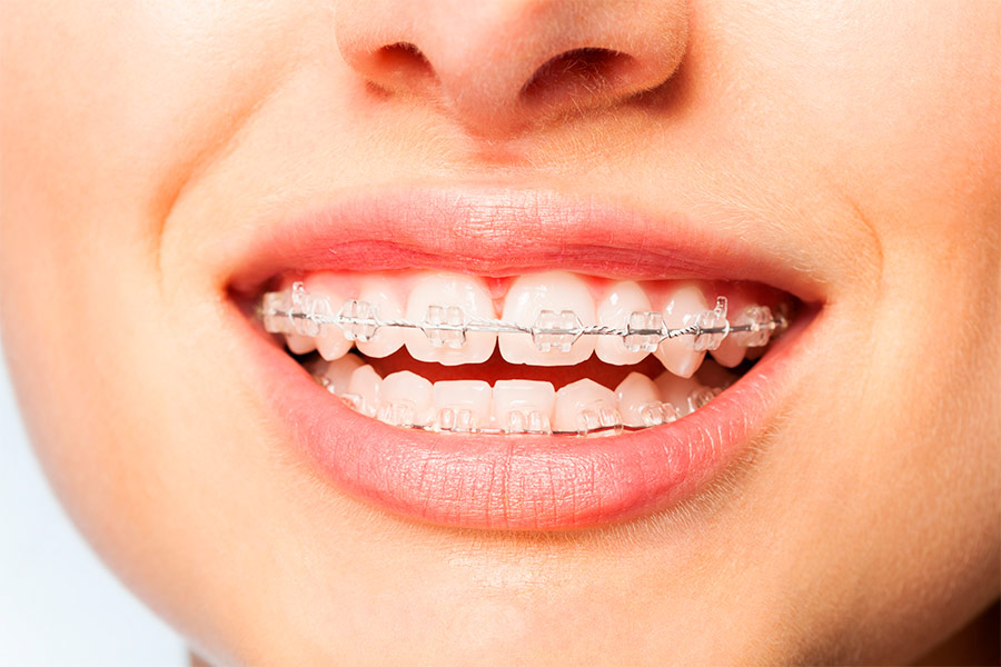 chica sonriendo con brackets estéticos